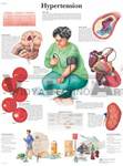 Hypertension - Anatomical Chart